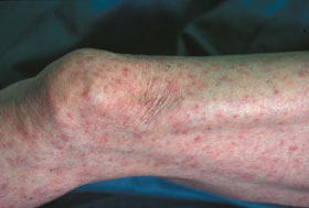日本紅斑熱患者の足に出た発疹の写真