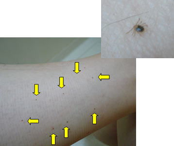 多数のキチマダニの若虫に吸着された足の写真