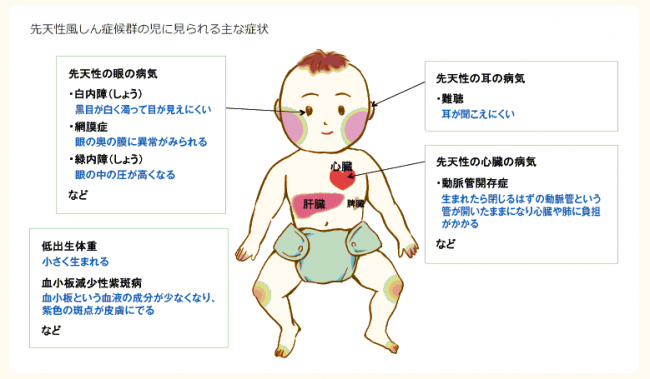 先天性風しん症候群の児に見られる主な症状