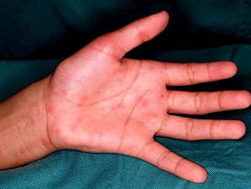日本紅斑熱で手のひらに発疹が出ている写真