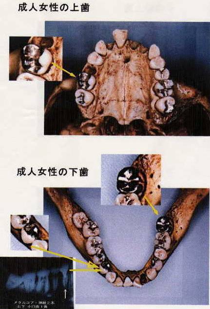 成人の歯形の写真