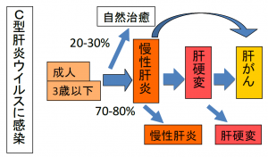 Ｃ型慢性肝炎は時間をかけて肝硬変，肝がんへと進行します。