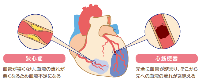 心疾患とは