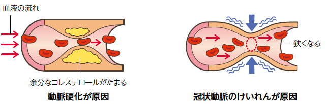 「狭心症」の画像