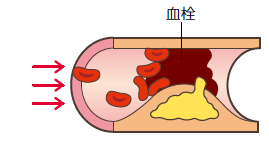 「心筋梗塞」の画像