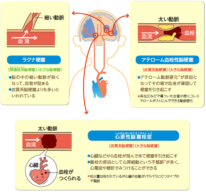 血管が詰まるタイプ（脳梗塞）