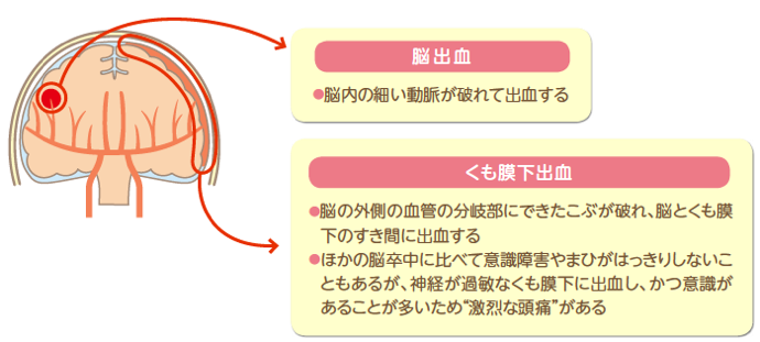 血管が破れるタイプ（脳出血・くも膜下出血）