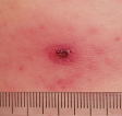 日本紅斑熱患者のダニの刺し口と発疹の写真へのリンク