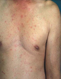 Accidental rashes in typhoid fever - rd.springer.com