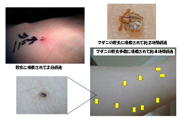 マダニの感染症 重症熱性血小板減少症候群 ｓｆｔｓ に注意しましょう 広島県感染症 疾病管理センター ひろしまｃｄｃ 広島県